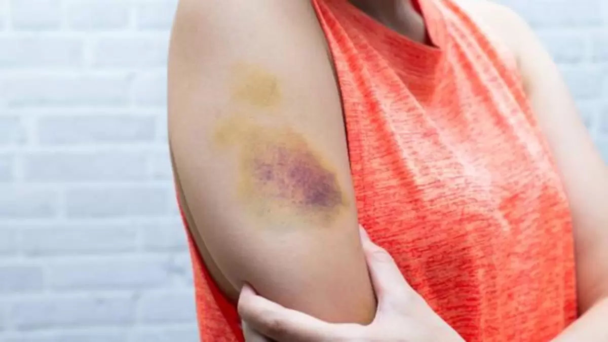 Understanding Hematoma: Symptoms, Causes, and Treatment