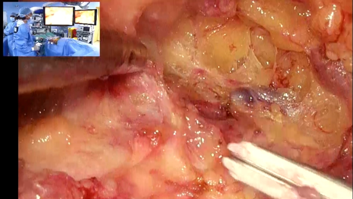 The Top Urologist in Kolkata, Dr. Tarun Jindal Performs Live VEIL Surgery at UroOncoCon 2026-HE